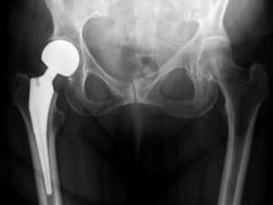 Blog Asheville Business Attorney hip replacement 2 Daniels Law Firm